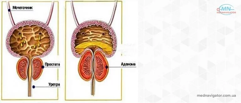 Аденома простаты