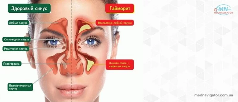 Лечение синуситов (гайморита, фронтита, сфеноидита)