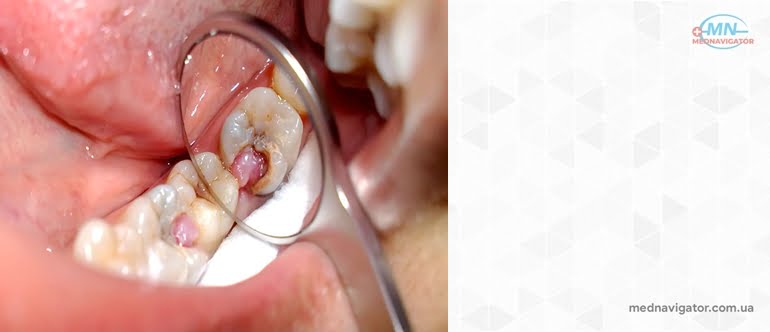 Болезни зубов и полости рта