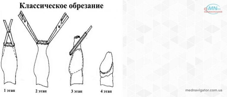 Как делается обрезание у мужчин схема и зачем