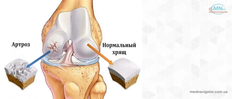 Артроз и его причины