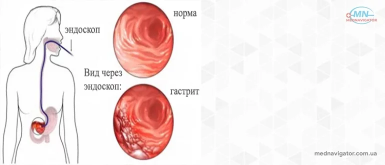 Гастрит или послепраздничный синдром