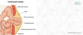 Грыжа