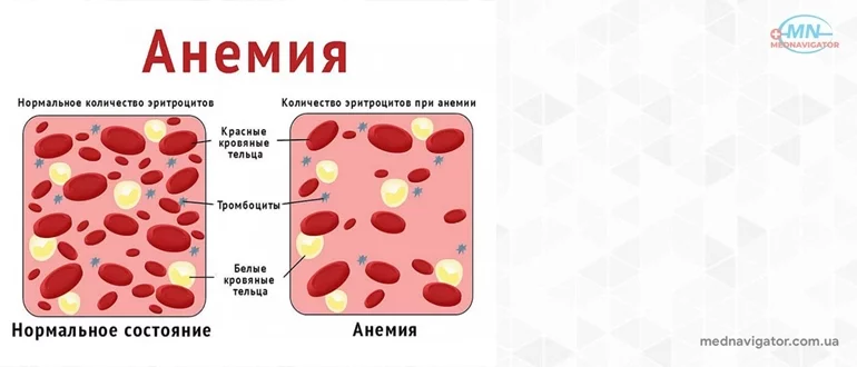 Анемии. Причины и лечение анемий