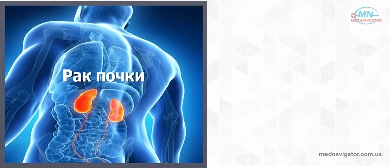 Рак почки