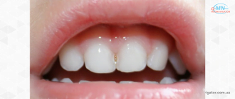 Серебрение зубов: особенности, показания