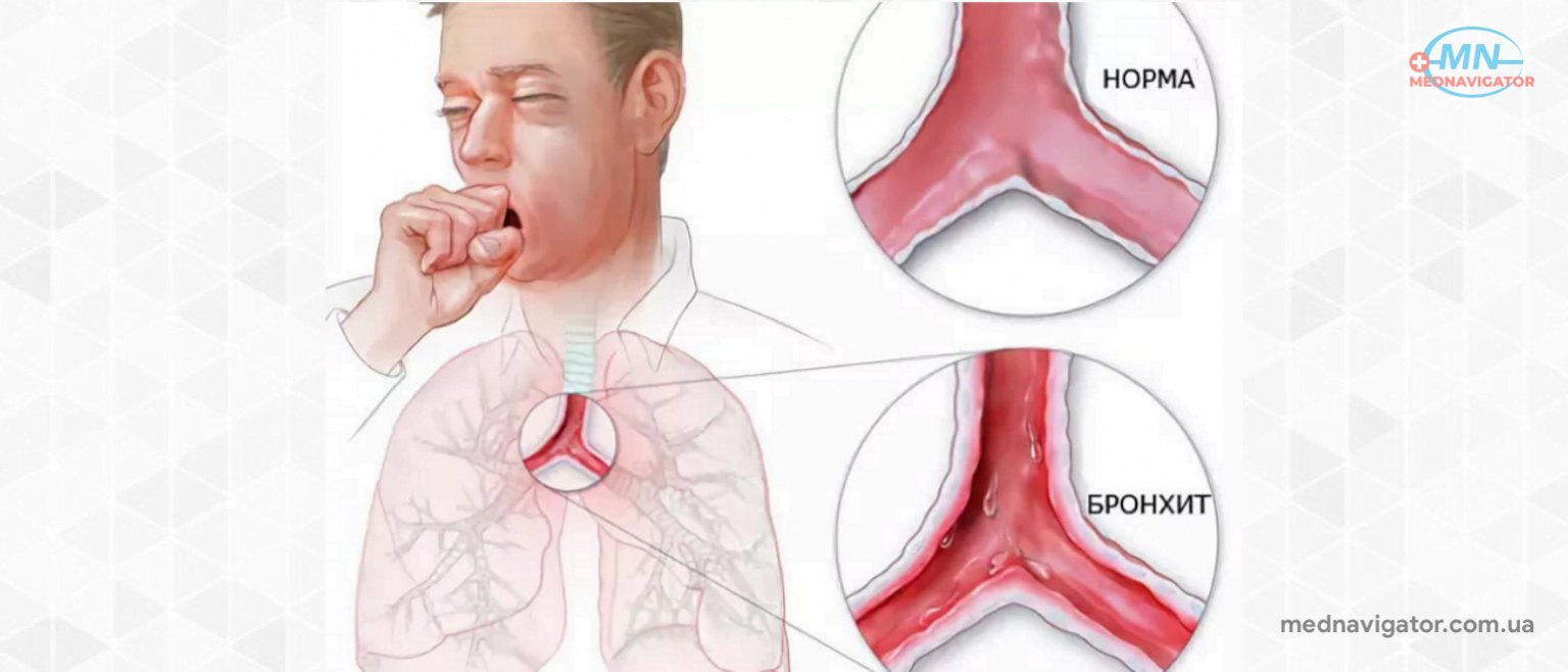 Кашель при трахеите у взрослого. Острый трахеит бронхит. Заболевания органов дыхания трахеит.