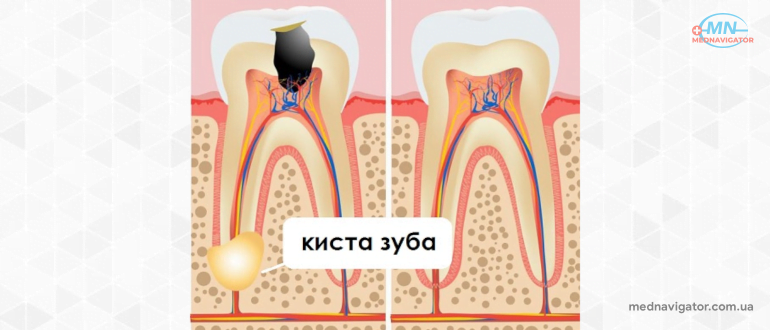 Киста зуба – причины, симптомы, диагностика