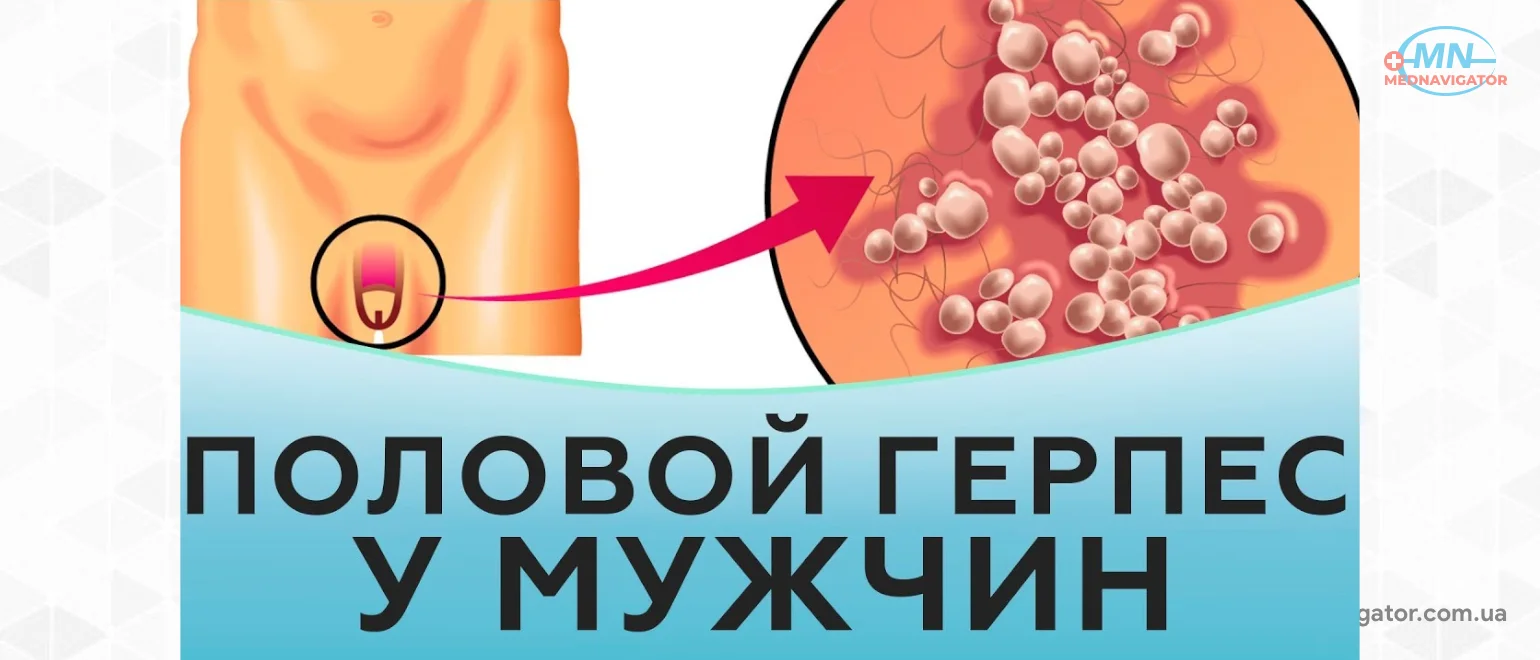 Генитальный герпес у мужчин