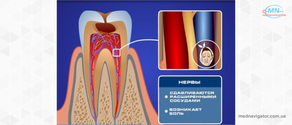 Острая зубная боль - лечение