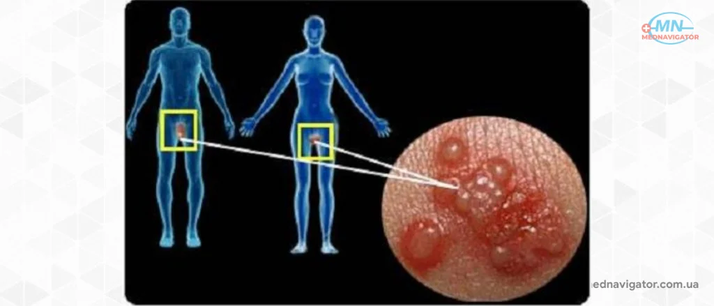 Генитальный герпес у мужчин