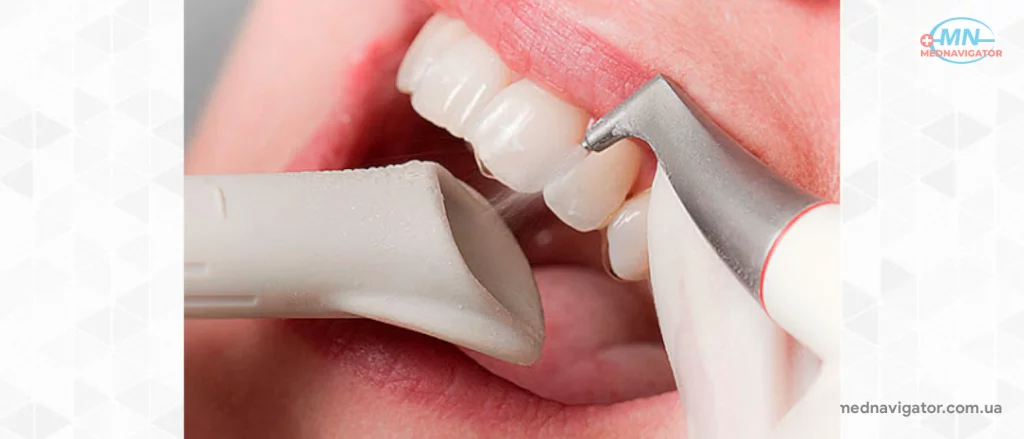 Как часто можно отбеливать зубы?