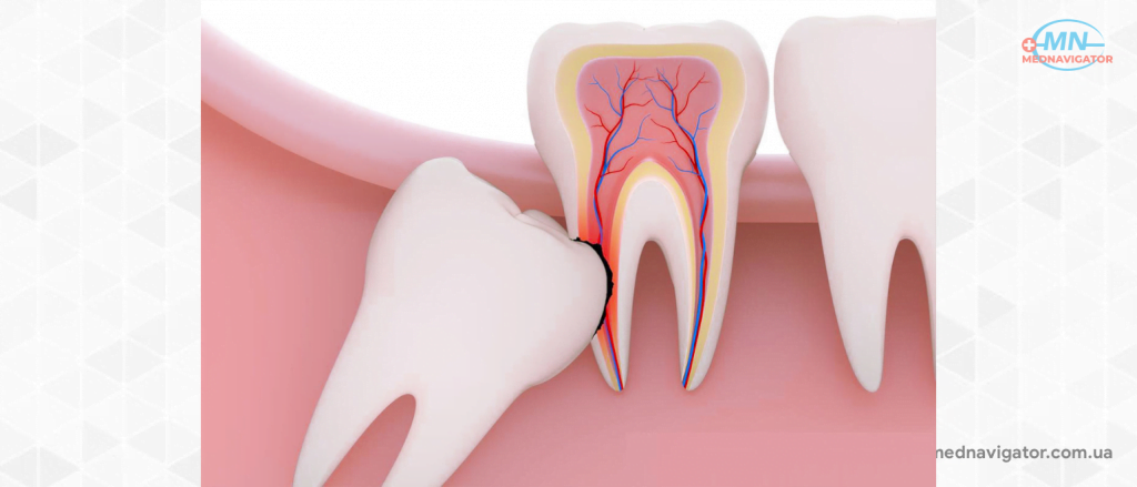 Киста зуба – причины, симптомы, диагностика