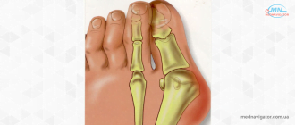 Hallux valgus (вальгусная деформация первого пальца стопы): причины, симптомы и лечение