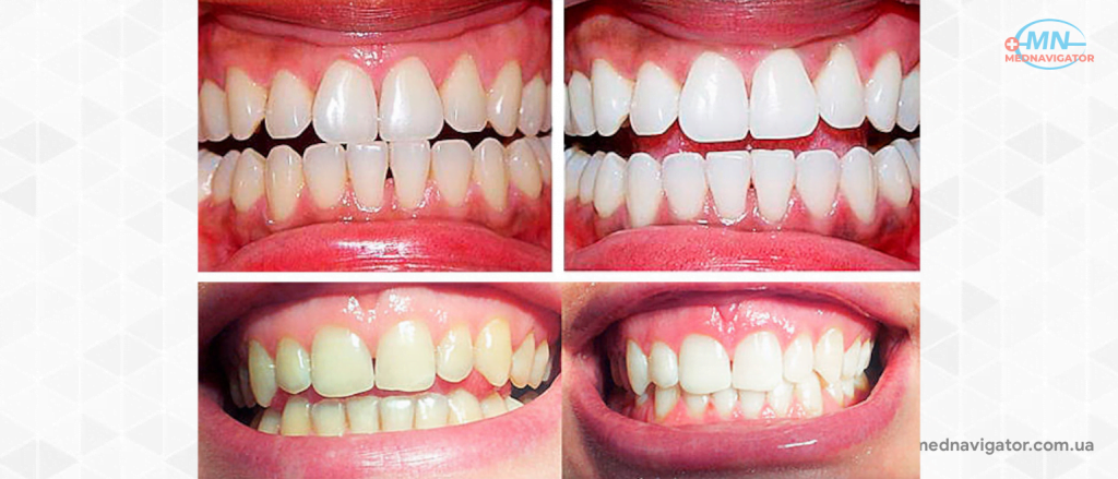 4 самых больших недостатка отбеливания зубов