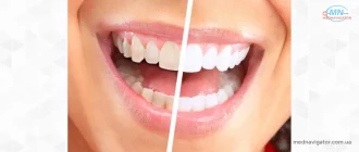 Как эффективно отбелить зубы с помощью 6 натуральных средств?