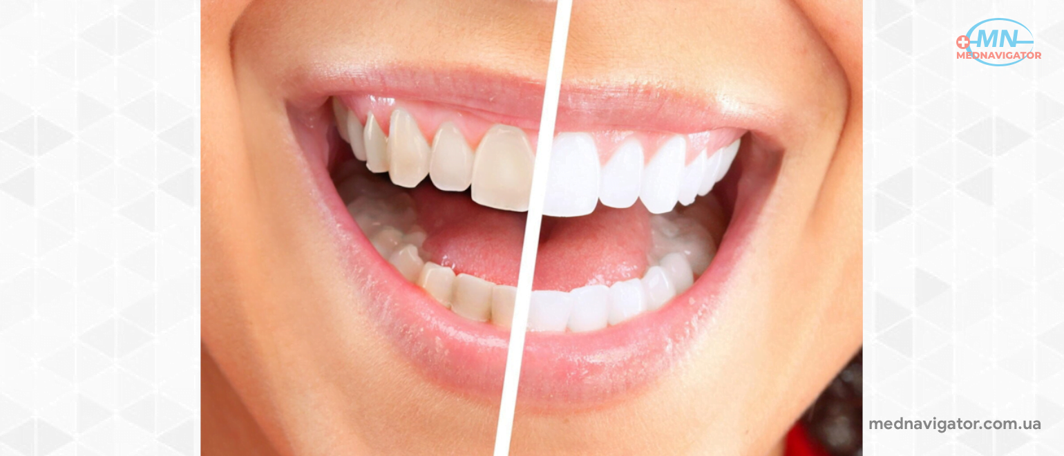 Как эффективно отбелить зубы с помощью 6 натуральных средств?