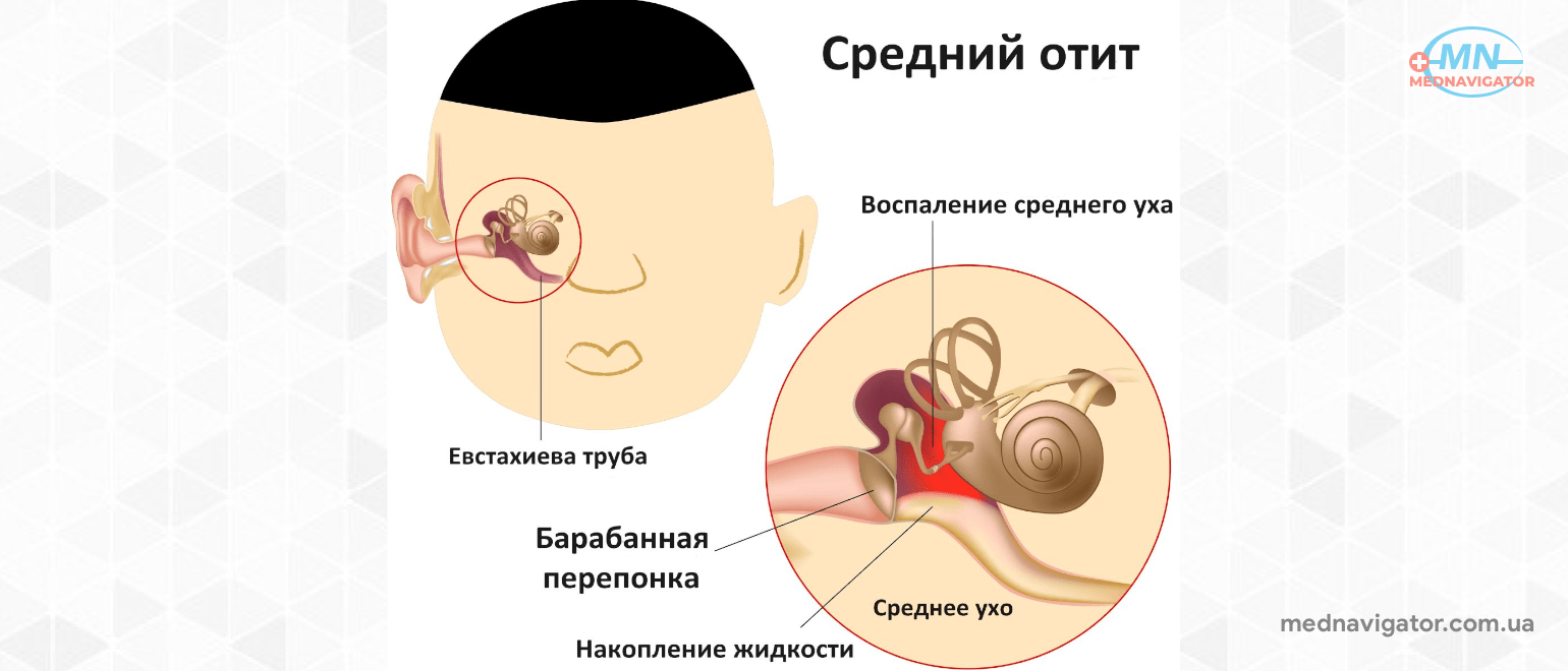 Отит схема. Хронический Гнойный средний отит симптомы. Наружный отит барабанная перепонка. Хронический Гнойный отит уха.