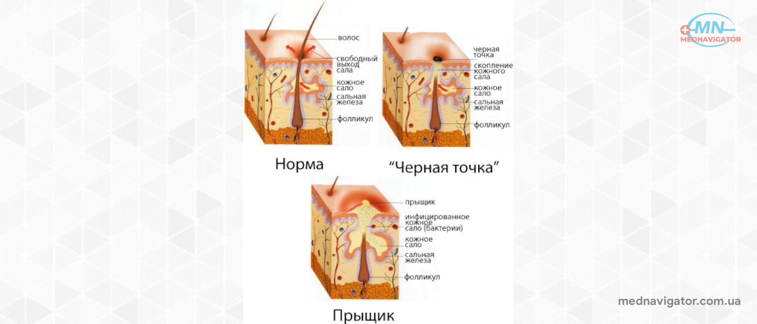 Повышенные андрогены у женщин. Андрогены у женщин повышены. Гормоны отвечающие за сальные железы.