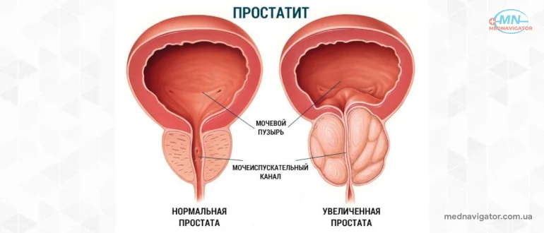 Симптомы простатита