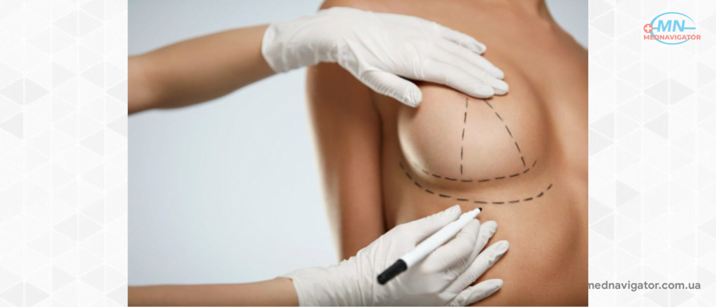 Подтяжка груди: причины деформации груди, преимущество мастопексии