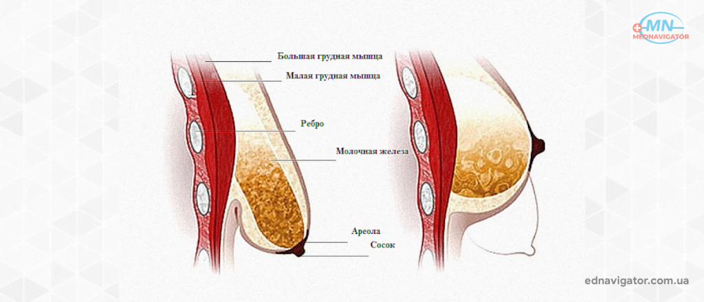 Подтяжка груди: причины деформации груди, преимущество мастопексии