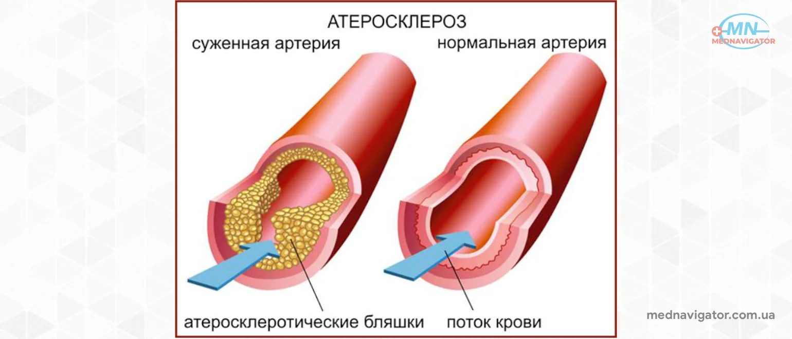 Лучшая натуральная помощь при высоком уровне холестерина