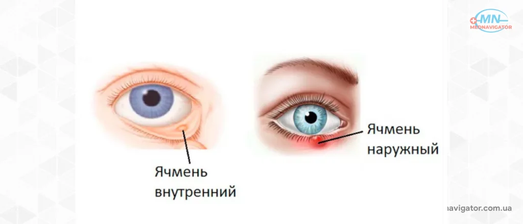 Ячмень на глазу: симптомы, причины